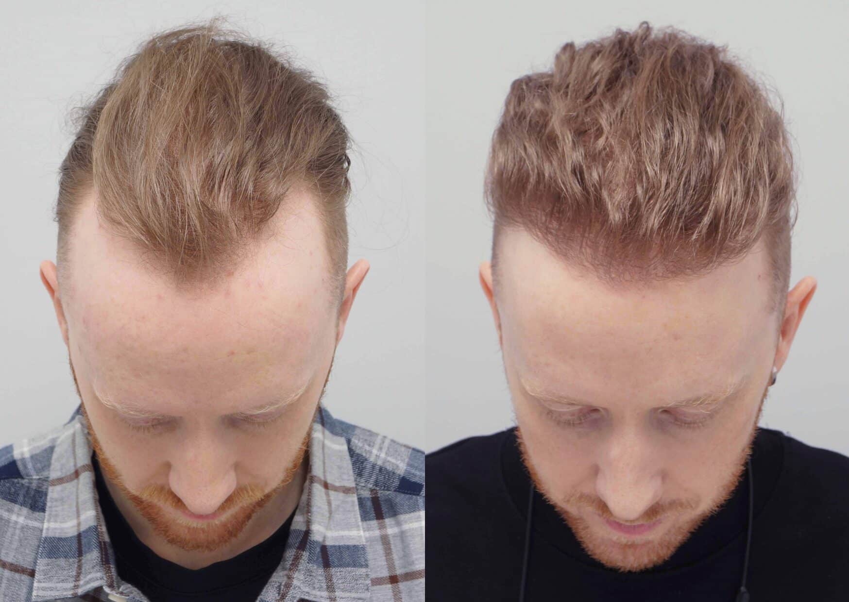 Hair Transplant – How It Works and What to Expect