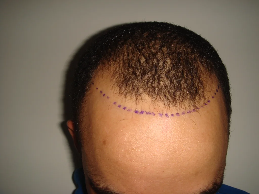 Hair Transplant UK – The Best Clinics and What to Expect