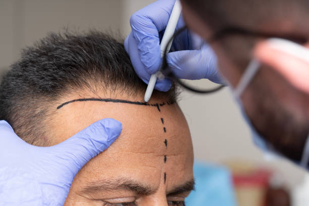 How Much Is Hair Transplant and Is It Worth It?